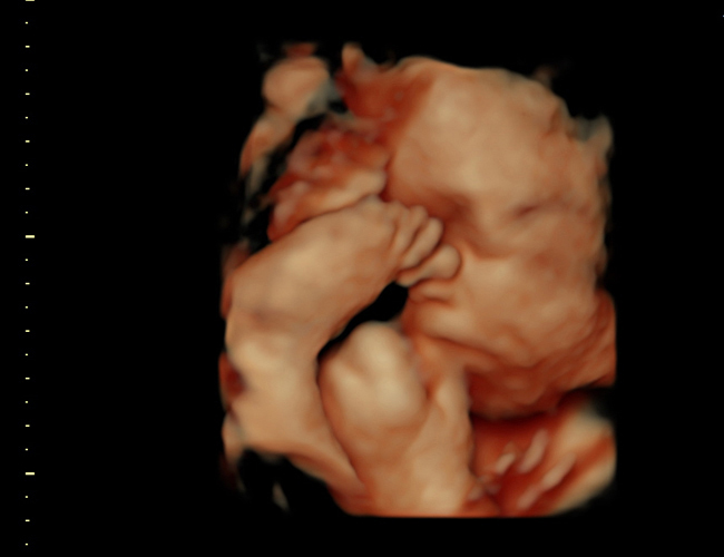 3D ultrasound image at 31 weeks